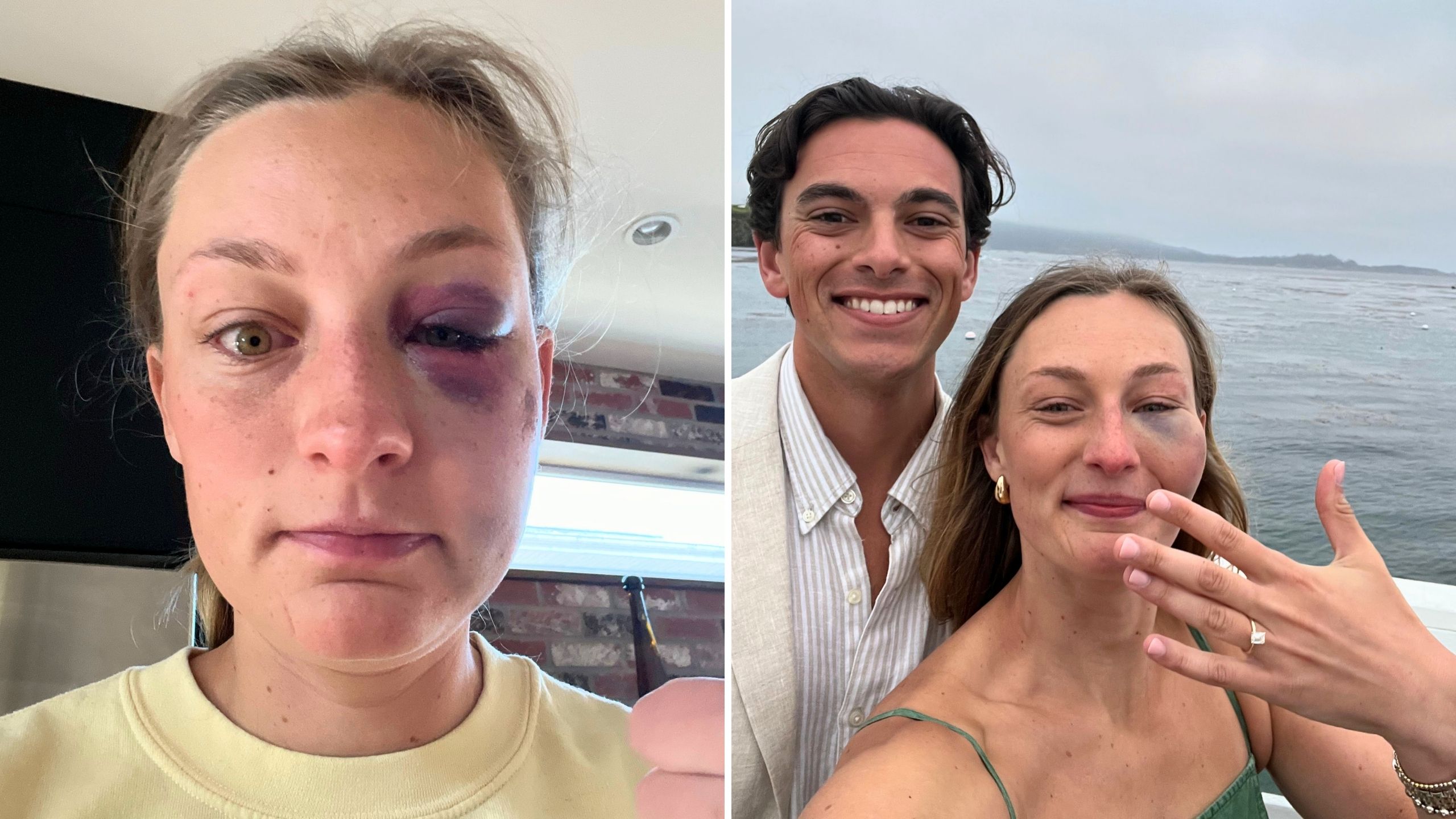 Girlfriend Rocks Huge Black Eye For Proposal 'Like A Champ' After Getting Hit By Golf Ball